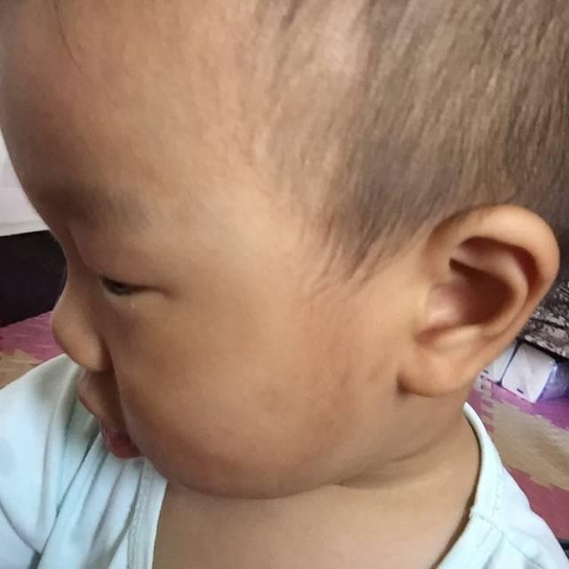 宝宝湿疹了怎么办?