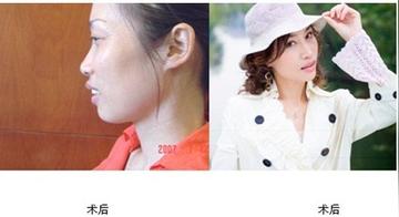 厦门整容闻名莫琳娜的相关长尾关键词有哪些