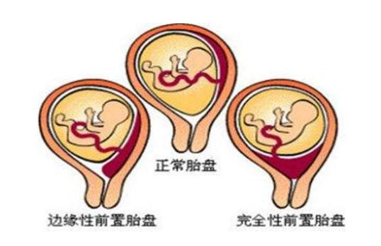 做四维胎盘低置怎么办