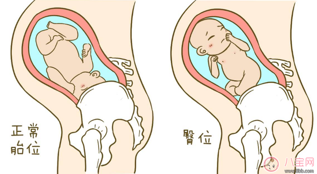 胎位不正的三种类型