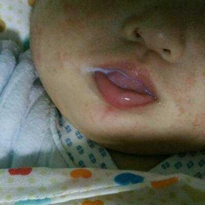 八个月宝宝嘴角疱疹图图片