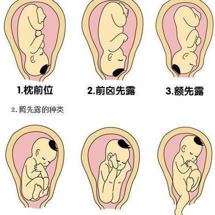 胎盘位置 宫底图片