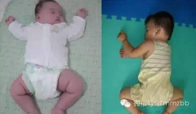宝宝臀纹不对称一定是有问题吗