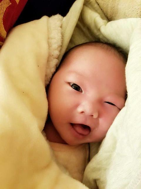 新生儿出生常见症状