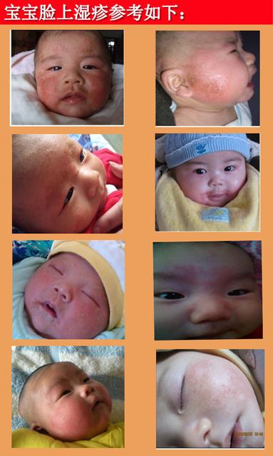 新生儿湿疹怎么治疗 新生儿湿疹怎么治疗