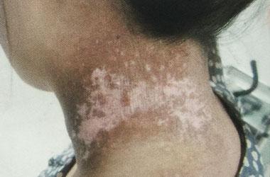 小宝宝颈部怎么护理才不红