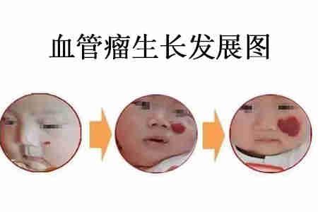 婴儿血管瘤严重吗