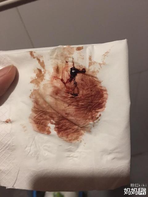 排卵期出血是怎么回事怎么治疗