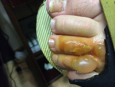 被烫伤后起了水泡 最好如何处理