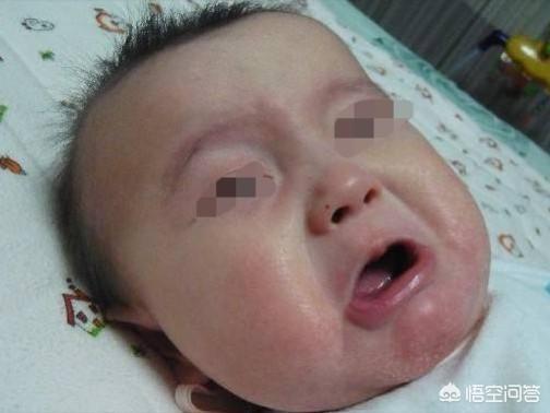 宝宝湿疹可以洗澡吗
