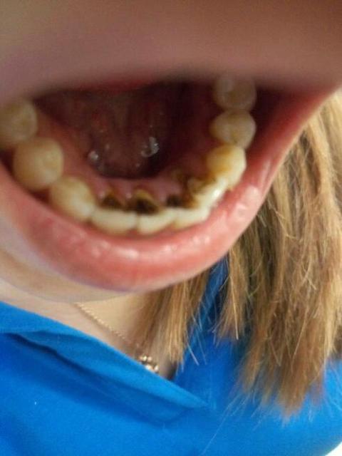 常喝咖啡会使牙齿变黄吗