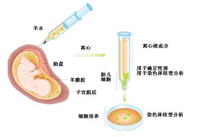 做羊水穿刺的准确率有多高