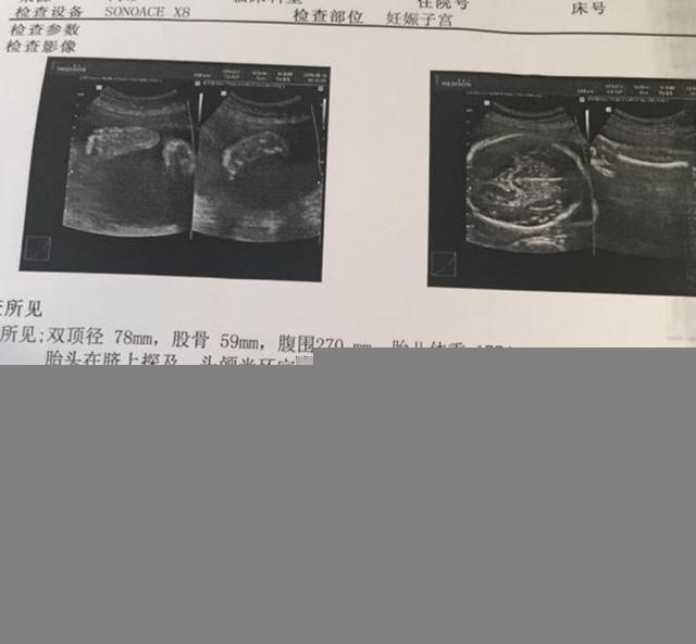 胎位不正臀位怎么办