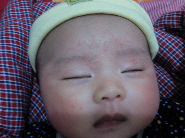婴儿脸上老长热疹怎么办