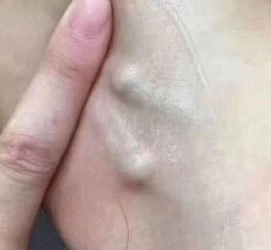 3,脑部循环差,供血部足,供氧不足.4,颈部淋巴结肿大,长痘.