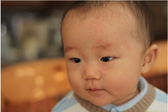 婴儿玫瑰疹是什么病
