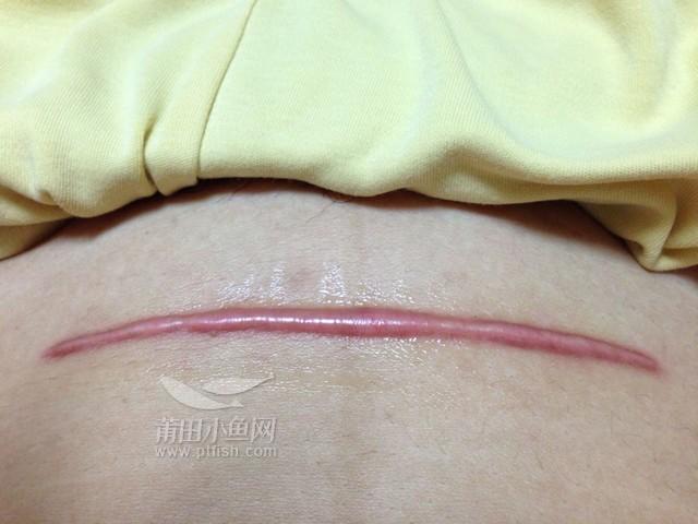 剖腹产后伤口增生了怎么办
