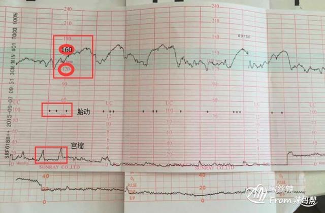 孕妇胎心监护有必要做吗