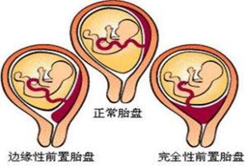 预防胎盘前置的方法