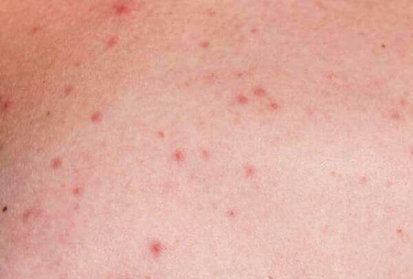 后背长痘是螨虫吗?