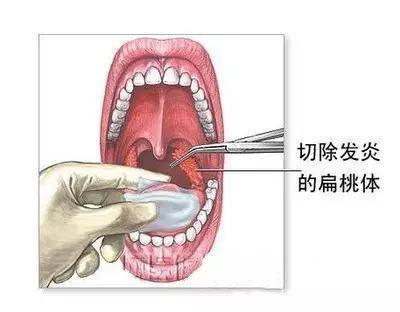 儿童扁桃体切除后对身体有什么影响