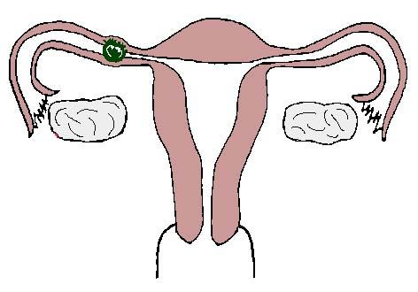 宫外孕有什么症状或征兆吗