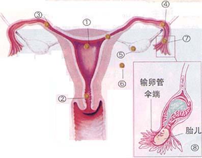 宫外孕食疗流产