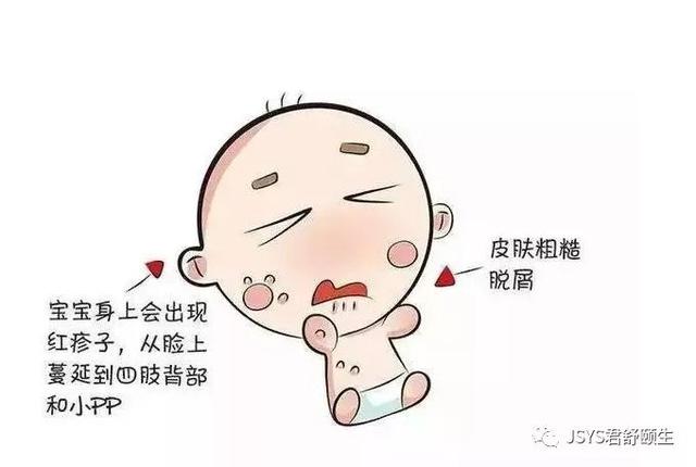 如何避免小儿湿疹