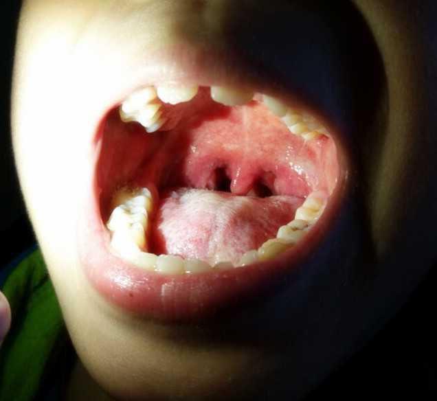 小儿疱疹性咽峡炎过程图片