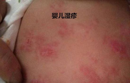 宝宝热疹和湿疹有什么区别
