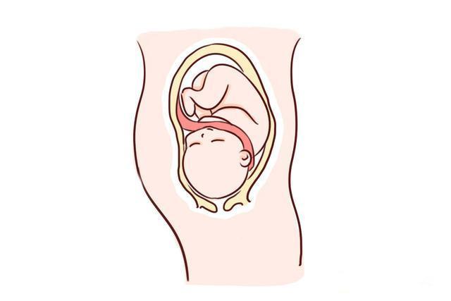 怎么避免胎宝宝脐带绕颈