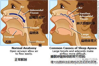 儿童腺样体肥大如何治疗