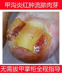 小孩甲沟炎用什么药好