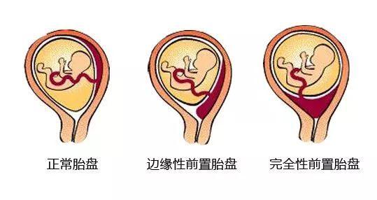 胎盘不能正常娩出的原因