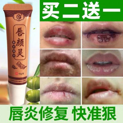 宝宝爱烂嘴角是上火了吗