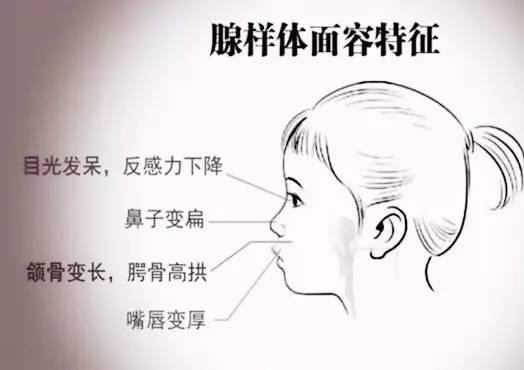 宝宝腺样体肥大吃什么食物好