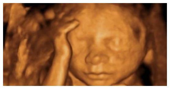 孕期做四维胎儿不配合怎么办