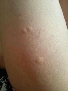 宝宝身上一抓就起疙瘩是怎么回事