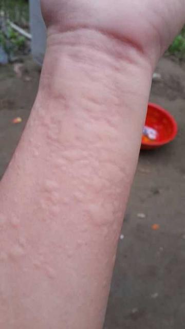 宝宝得了荨麻疹好了以后还会得吗