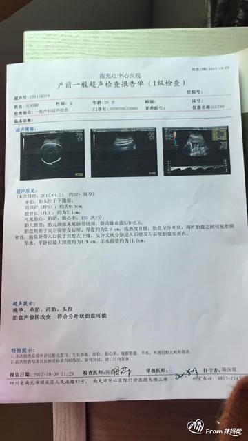 胎盘老化能顺产吗