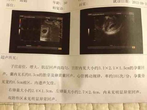 孕囊多大可以人流