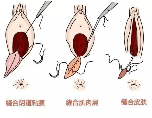 侧切伤口拆线后疼痛怎么办