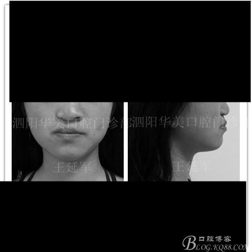 唇腭裂术后正畸案例