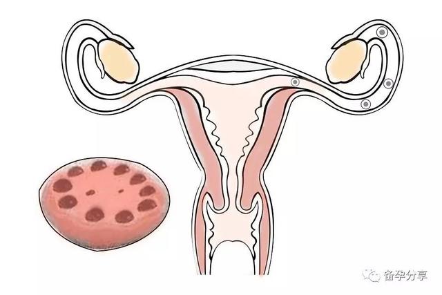 多囊卵巢怀孕了需要注意什么
