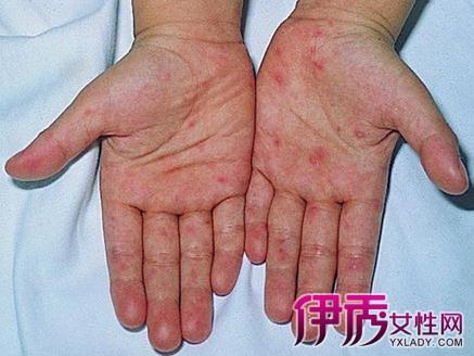 什么是手足口病