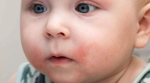 宝宝皮肤为什么会过敏