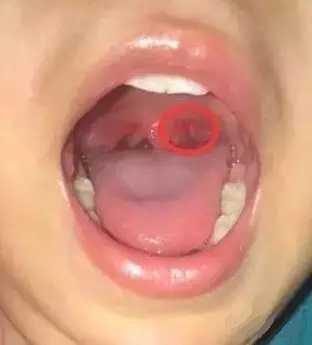 疱疹性咽颊炎可以自愈吗