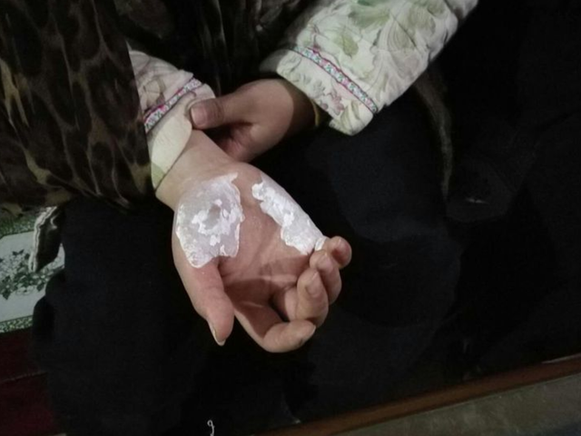 如果孩子被烫伤了怎么办