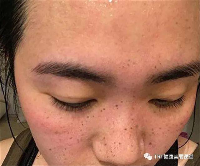 女性荷尔蒙分泌失调怎么办