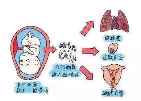 生产时羊水里有胎粪对宝宝有影响吗